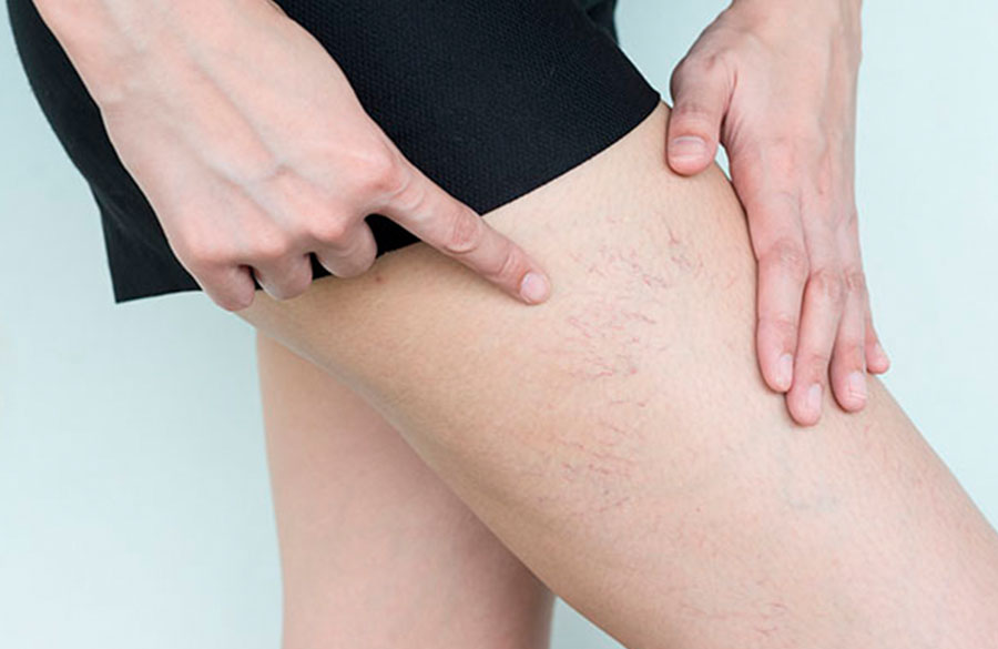 Arañas vasculares piernas en centro médico Ananda