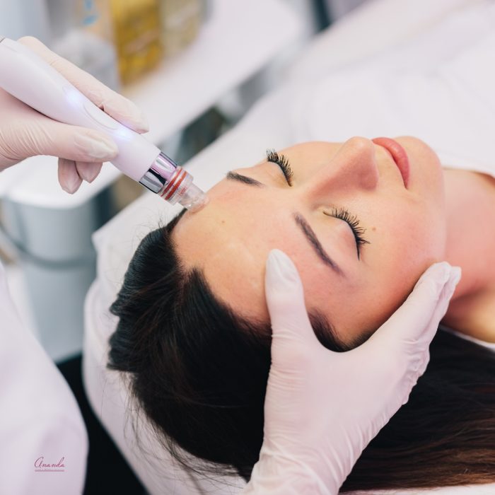 Neo Hidra facial Micropuncion Rejuvenecimiento IPL