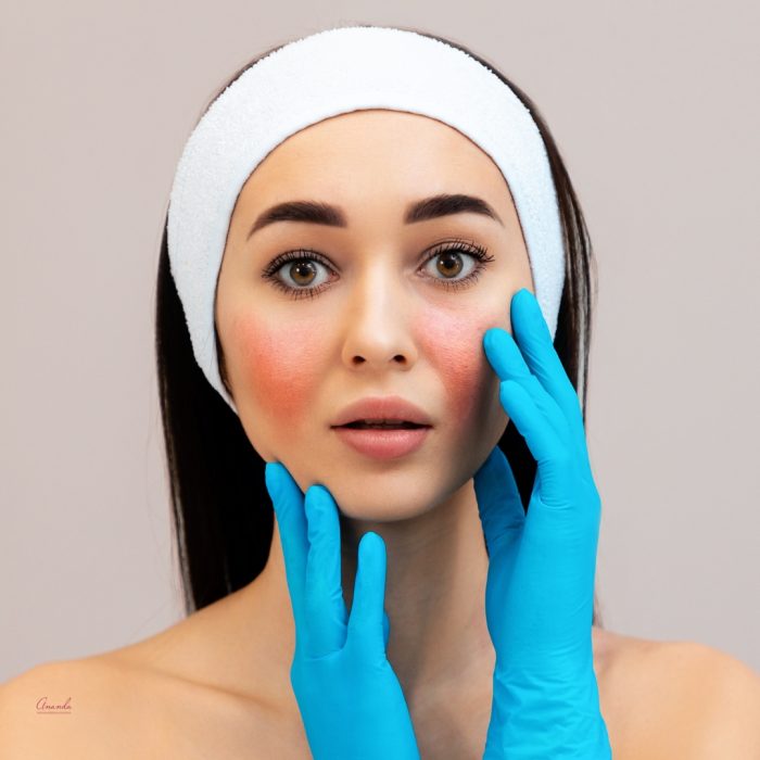 Tratamiento Rosacea o Couperosis