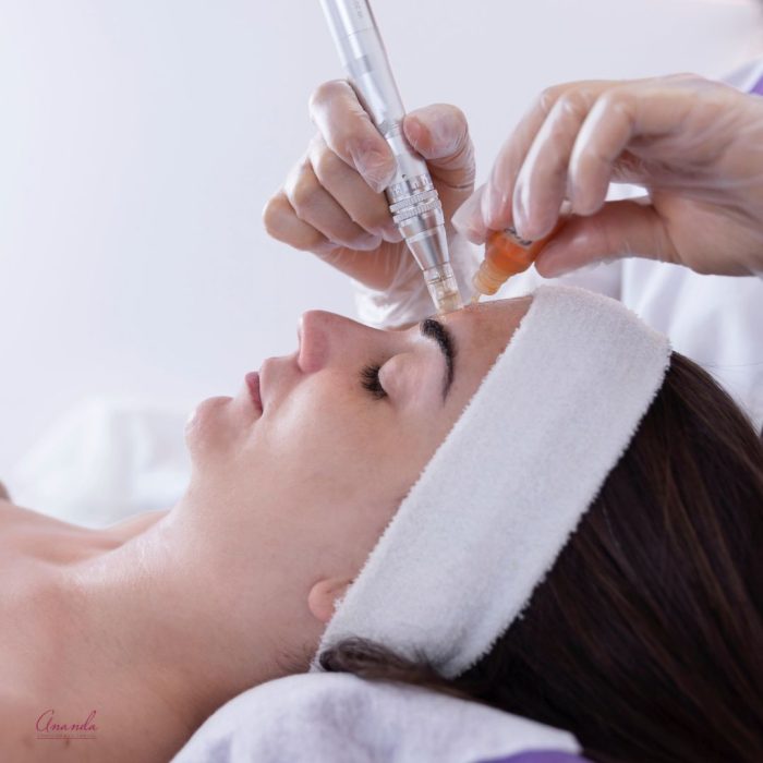 Hidratacion profunda con Micropunción o microneedling